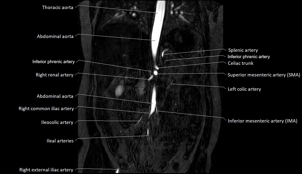 MRA Abdomen coronal anatomy image 17.webp